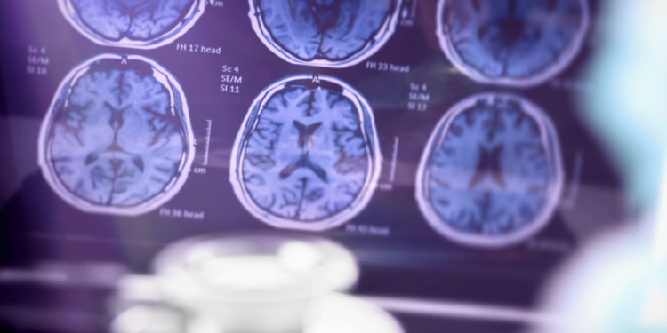 Neurologista explica quais são os sinais do início do Alzheimer