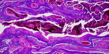 Oncologista lista principais sintomas do câncer de pele não melanoma