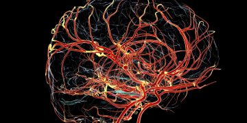 Alzheimer pode começar com a queda do fluxo sanguíneo, sugere estudo
