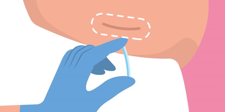 Implanon: saiba quem tem direito ao contraceptivo pela rede pública do DF