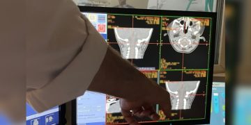 Fiocruz inicia teste em humanos de terapia gênica inédita contra AME