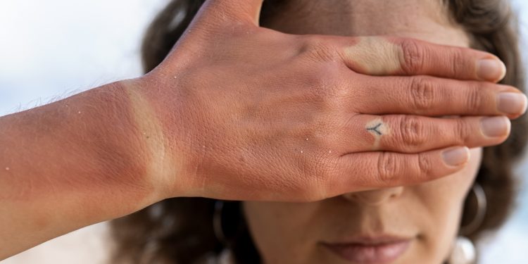 Protetor solar não evita insolação. Dermatologista ensina como se proteger