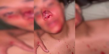 Adolescente fica com nariz desfigurado ao tomar tiro de borracha de PM