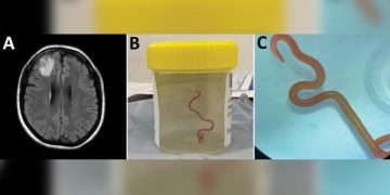 Verme parasita de cobra é encontrado pela 1ª vez no cérebro de humanos