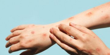 Mpox no DF: veja sintomas, tratamento e prevenção contra a doença