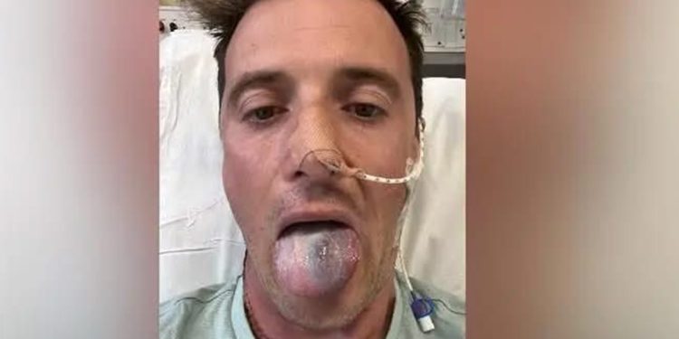 Homem desenvolve câncer por causa de HPV e quase perde a língua