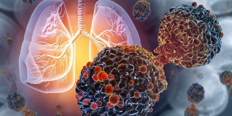 Oncologistas explicam os principais sintomas do câncer de pulmão