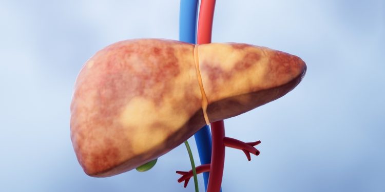 Câncer de fígado: geneticista alerta para sintomas