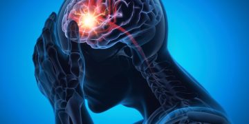 Neurocirurgião explica as causas e sintomas do aneurisma cerebral