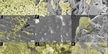 Estudo identifica DNA bacteriano em cálculos renais mais comuns