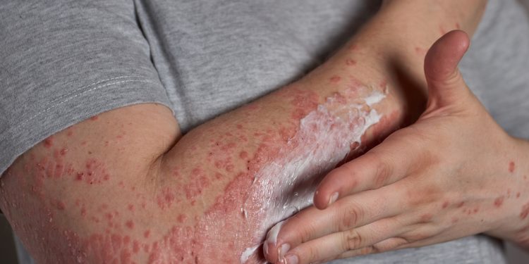 Estresse pode ativar e agravar crises de dermatite atópica, diz estudo