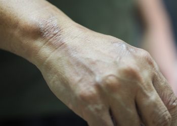 Sem preconceito: veja mitos e verdades sobre a hanseníase