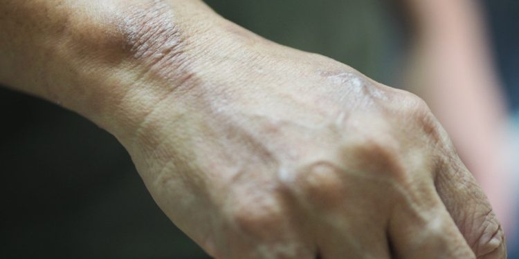 Sem preconceito: veja mitos e verdades sobre a hanseníase