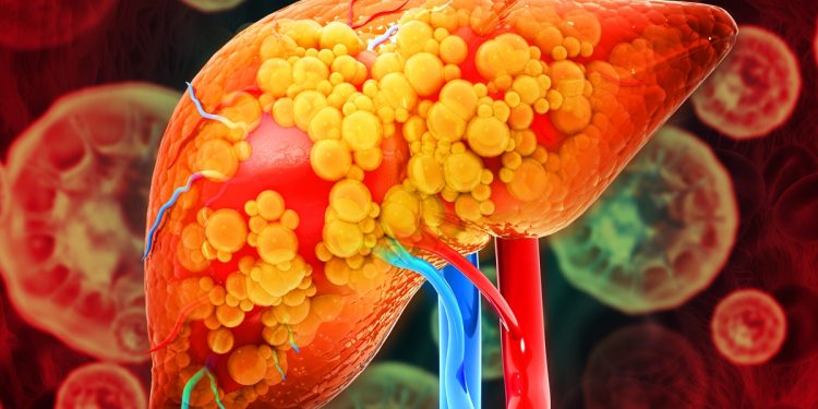 Exagerar no álcool às vezes pode triplicar risco de problema no fígado