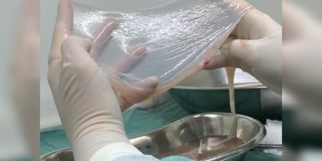 SUS amplia uso de tecido amniótico para tratar pacientes com diabetes