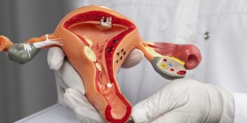 Sem sintomas? Saiba sinais e como prevenir câncer de colo do útero