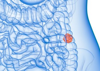 Câncer de intestino: vilões comuns na dieta que você precisa conhecer