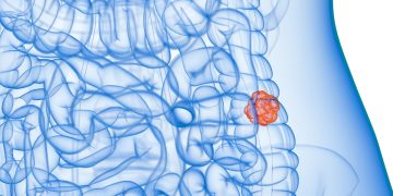 Câncer de intestino: vilões comuns na dieta que você precisa conhecer