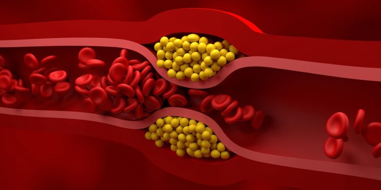 Existem sintomas de colesterol alto? Endocrinologista explica sinais