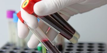 Exame de sangue pode detectar cicatrizes no fígado antes do câncer