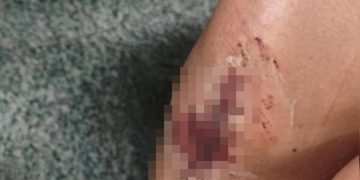 Jovem fica com feridas em carne viva após ser espancada por irmão e ex no DF