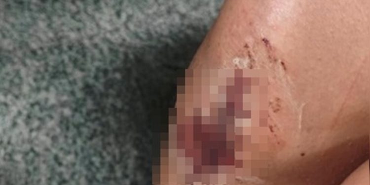 Jovem fica com feridas em carne viva após ser espancada por irmão e ex no DF