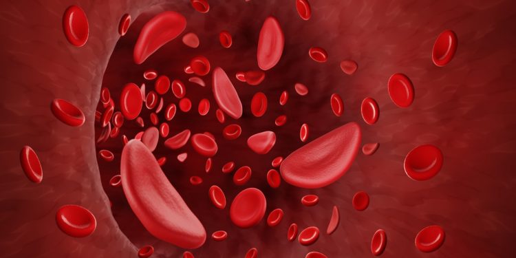 Anemia falciforme: saiba o que é e quais são os sintomas