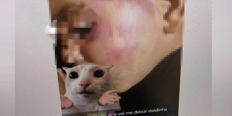 Mãe posta foto de filho espancado e padrasto é preso: “A fase de 1 ano vai me deixar doida” . Veja vídeo