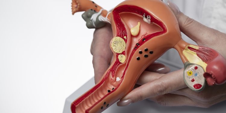 Médicas ensinam se síndrome do ovário policístico causa ganho de peso