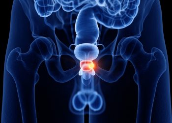 Urologista lista quais são os primeiros sintomas de próstata aumentada