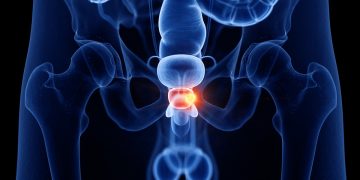 Hiperplasia da próstata pode aumentar a frequência urinária dos homens