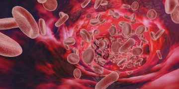 Anemia falciforme: entenda como é o tratamento e as crises da doença