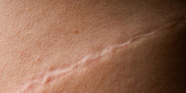 Especialistas diferenciam cicatriz comum da hipertrófica e do queloide