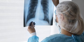 Pesquisa identifica 14 proteínas capazes de prever câncer de pulmão
