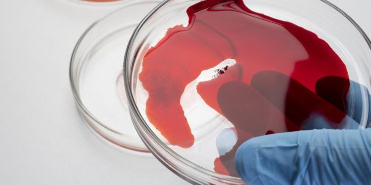 Exame de sangue ajuda a prever recidiva do câncer de pâncreas