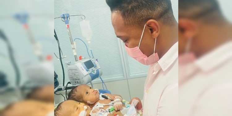 Nascidos unidos pelo abdômen, gêmeos siameses morrem em Goiânia. Veja vídeo