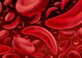 Anemia falciforme provoca dor crônica e afeta a qualidade de vida