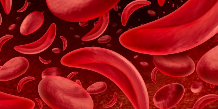 Anemia falciforme provoca dor crônica e afeta a qualidade de vida