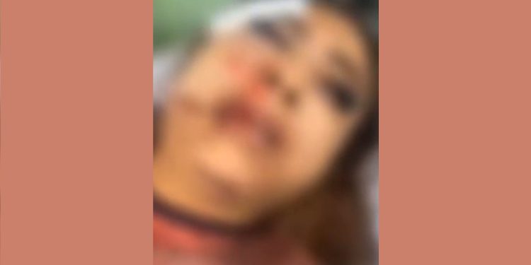 Garota de programa tem rosto desfigurado ao ser agredida por cliente